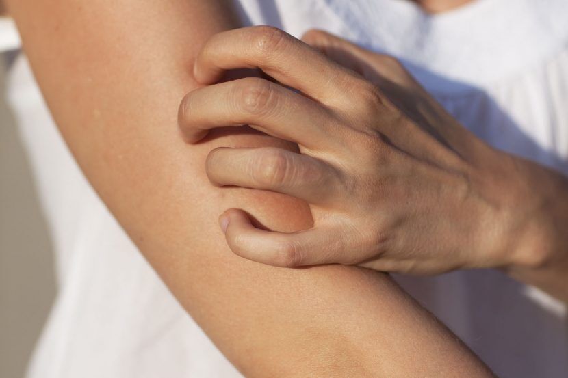 What is the difference between eczema and dermatitis